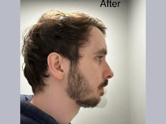 Facial advancement by Reptiles