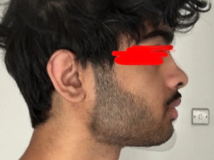 Side profile genioplasty by Reptiles